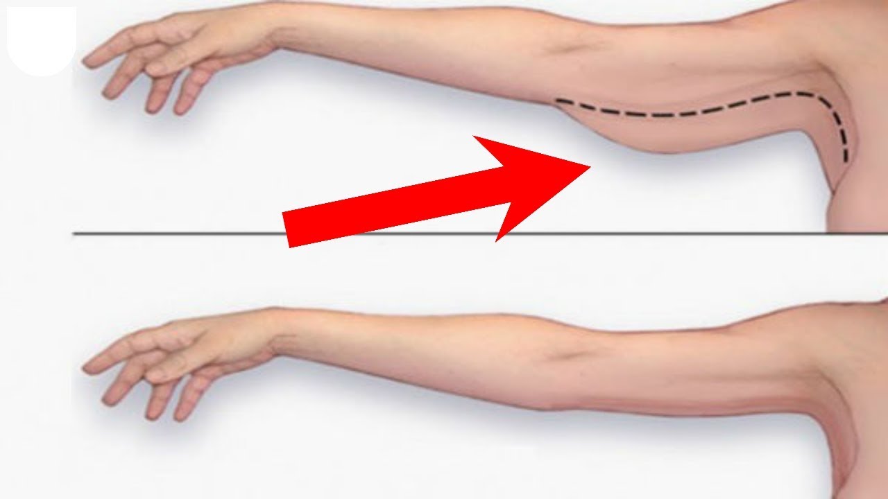 увиснала кожа на ръцете