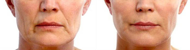 увиснала кожа