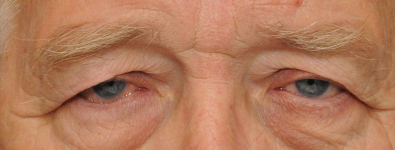 птоза на клепача